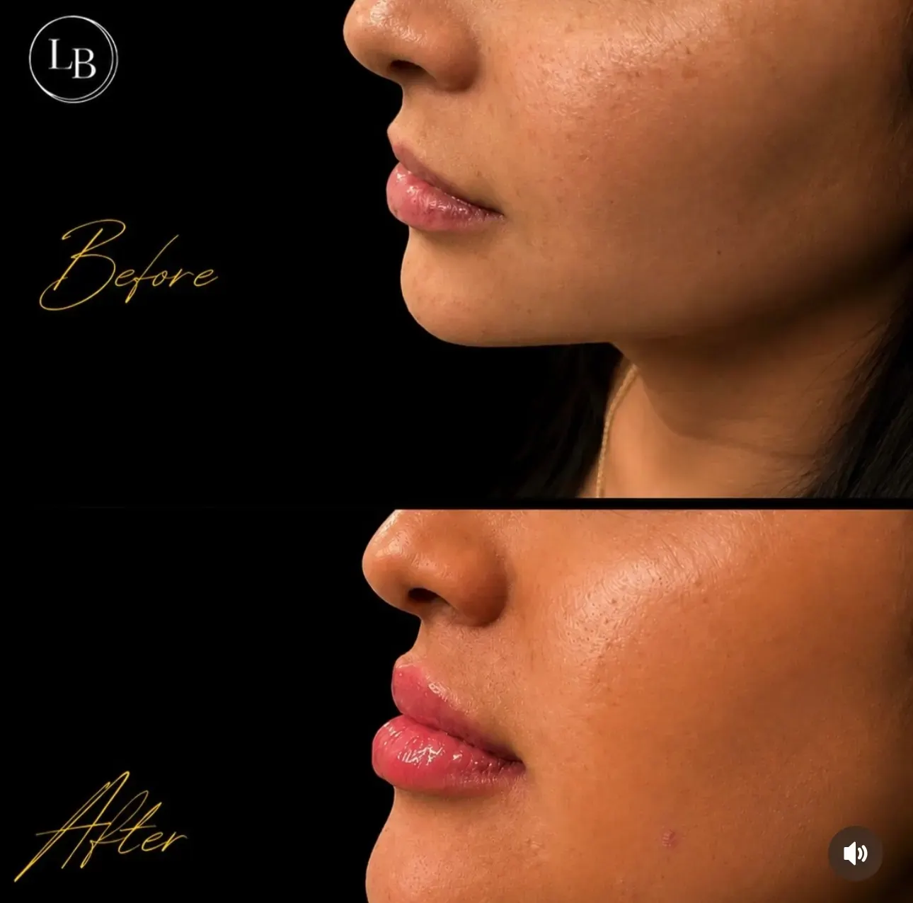 Before view of treatment result 1 at Luxury Beauty by Cleo R. in Oakville