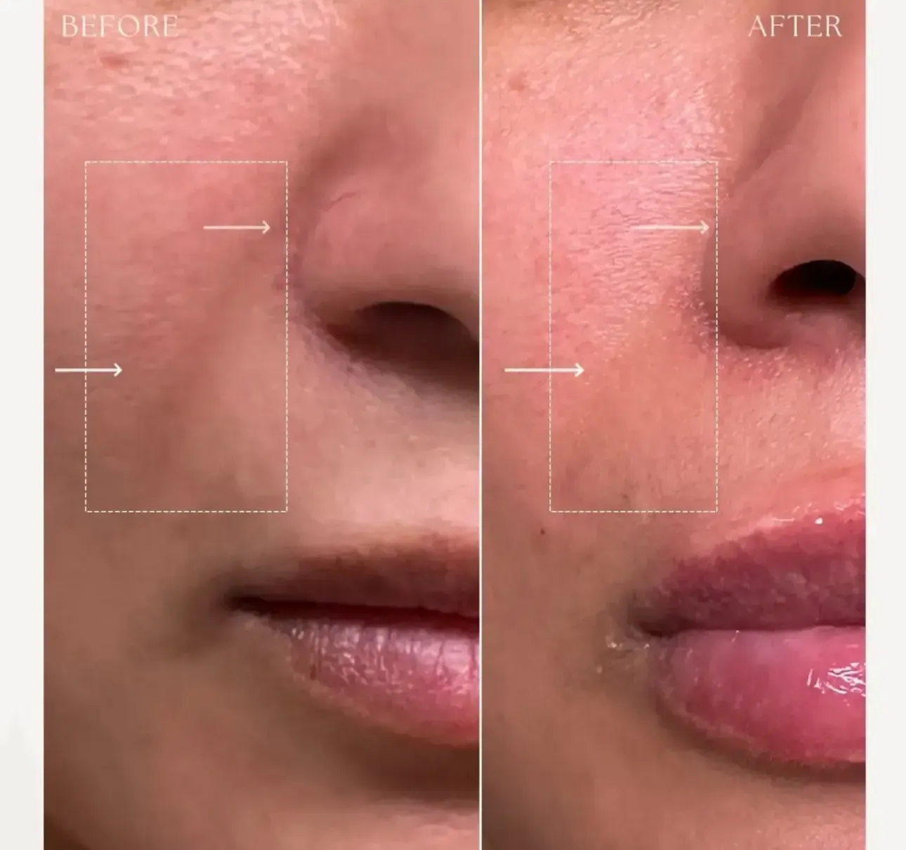 Before view of treatment result 3 at Luxury Beauty by Cleo R. in Oakville