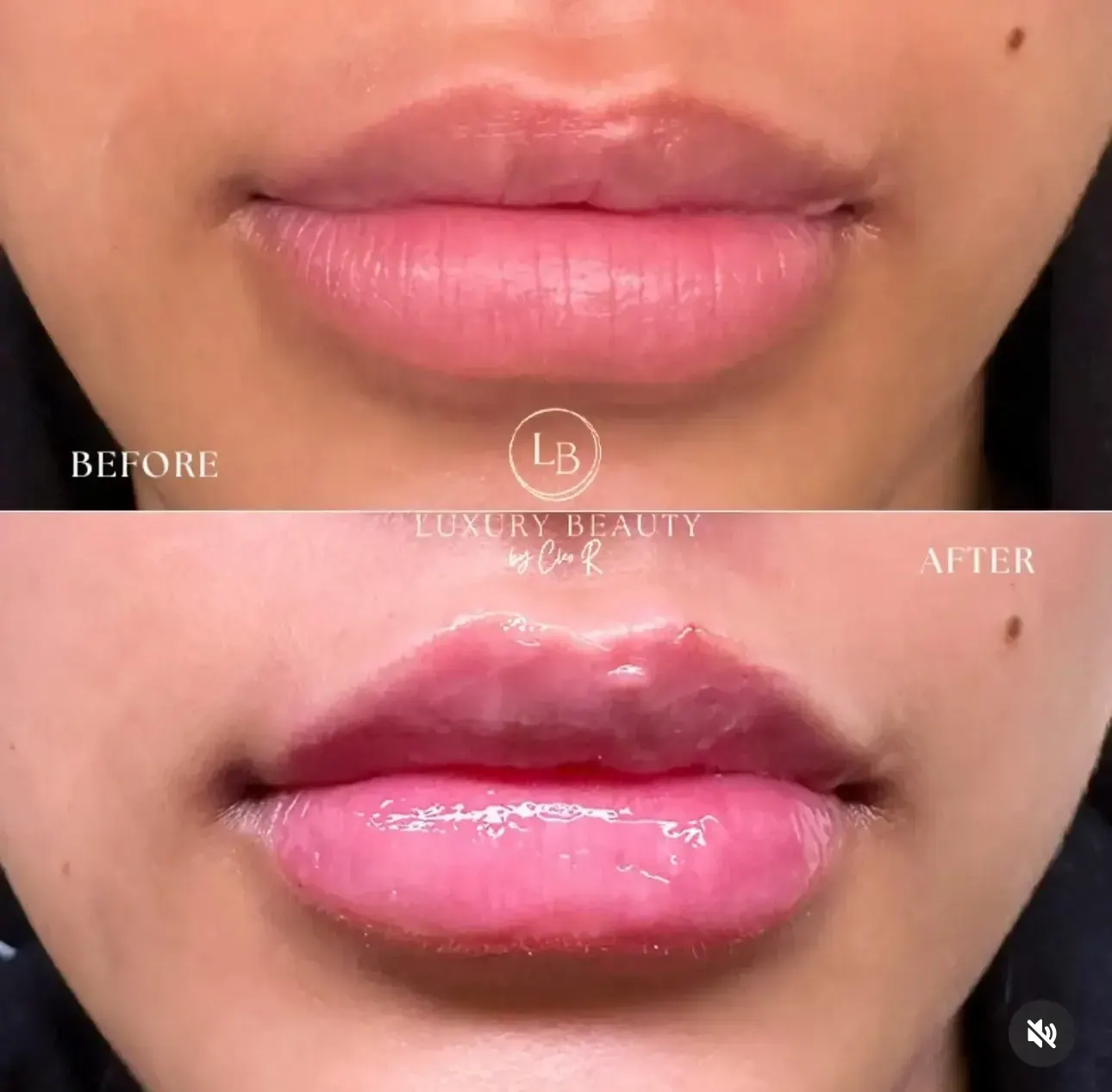 Before view of treatment result 4 at Luxury Beauty by Cleo R. in Oakville