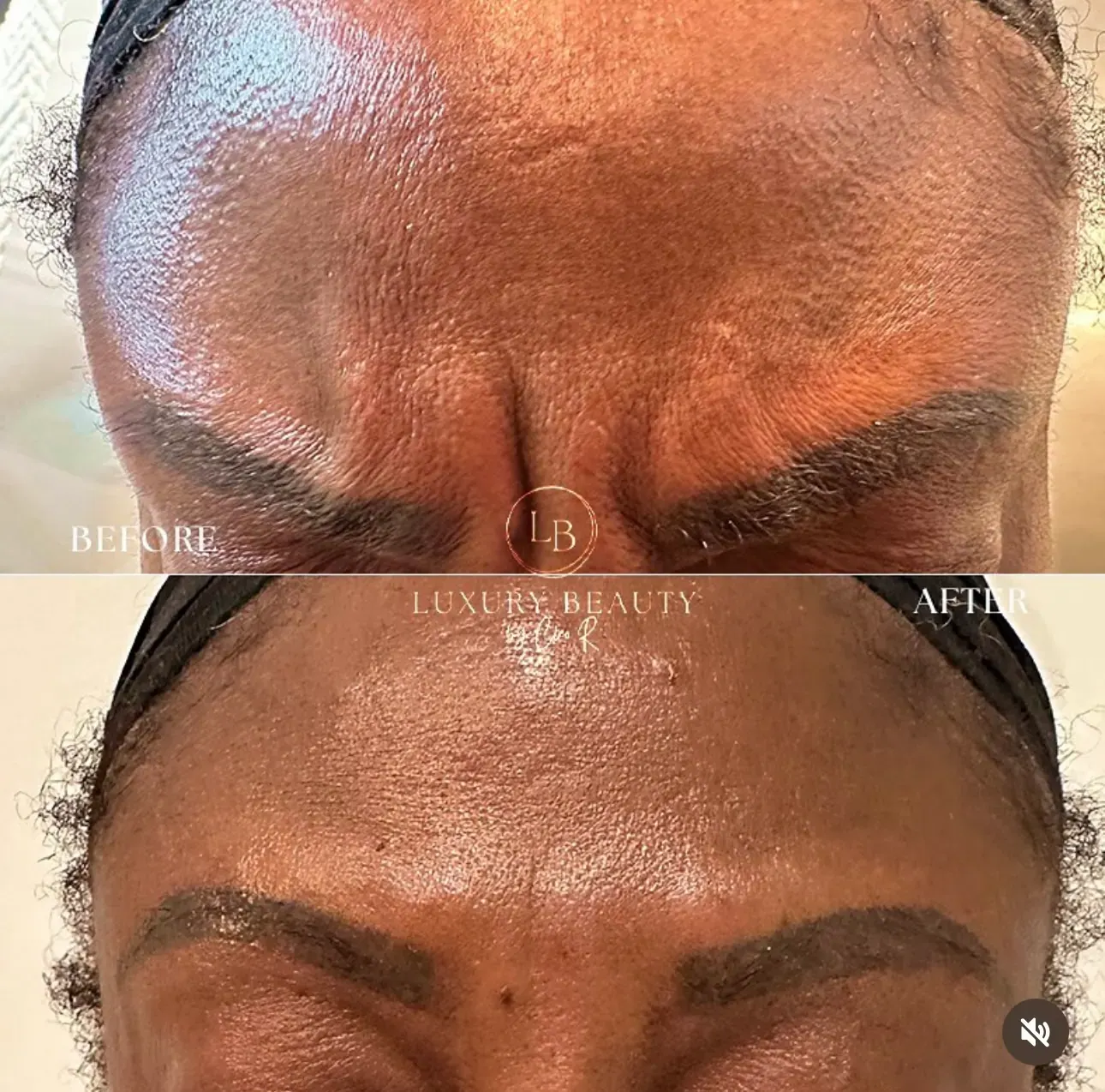 Before view of treatment result 5 at Luxury Beauty by Cleo R. in Oakville