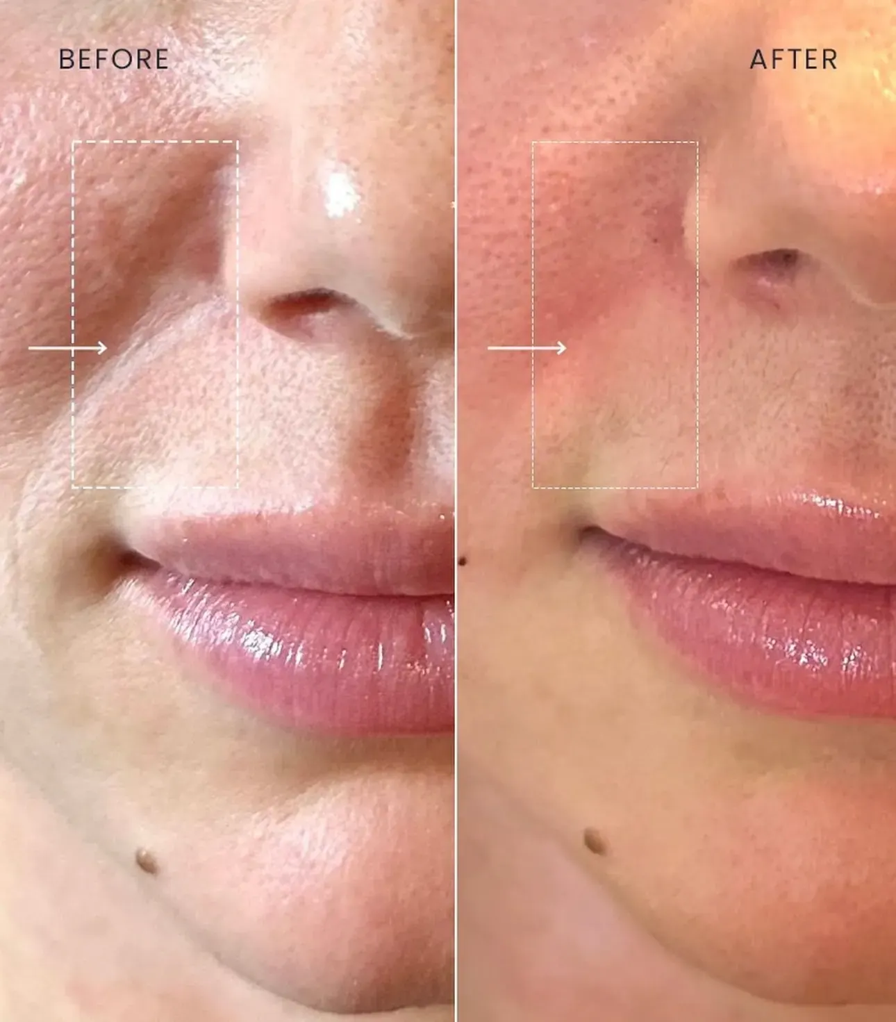 Before view of treatment result 6 at Luxury Beauty by Cleo R. in Oakville