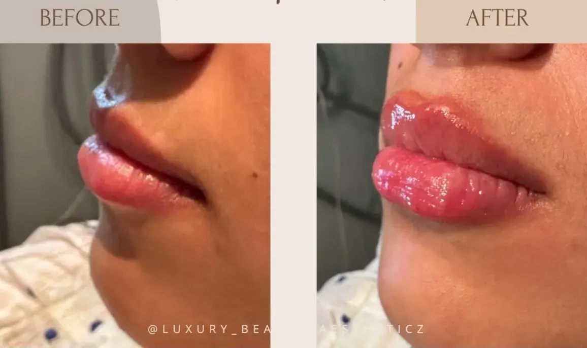 Before view of treatment result 7 at Luxury Beauty by Cleo R. in Oakville