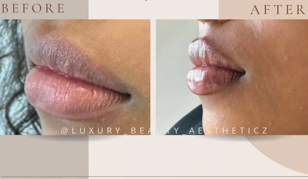 Before view of treatment result 8 at Luxury Beauty by Cleo R. in Oakville