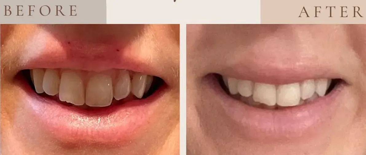 Before view of treatment result 9 at Luxury Beauty by Cleo R. in Oakville