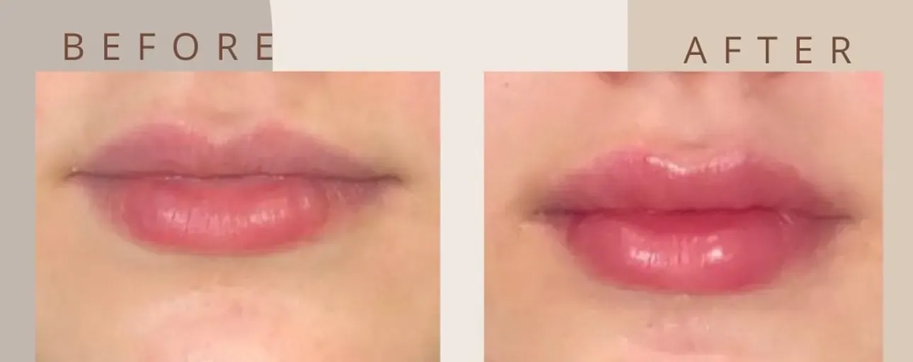 Before view of treatment result 11 at Luxury Beauty by Cleo R. in Oakville