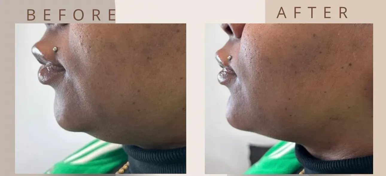Before view of treatment result 12 at Luxury Beauty by Cleo R. in Oakville