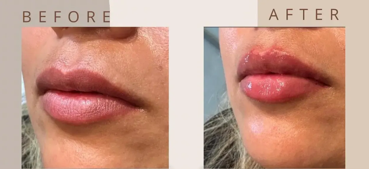 Before view of treatment result 13 at Luxury Beauty by Cleo R. in Oakville