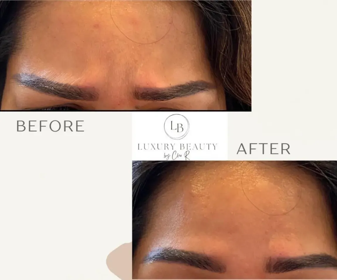 Before view of treatment result 14 at Luxury Beauty by Cleo R. in Oakville